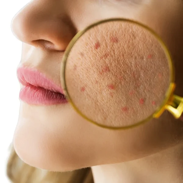 Acne