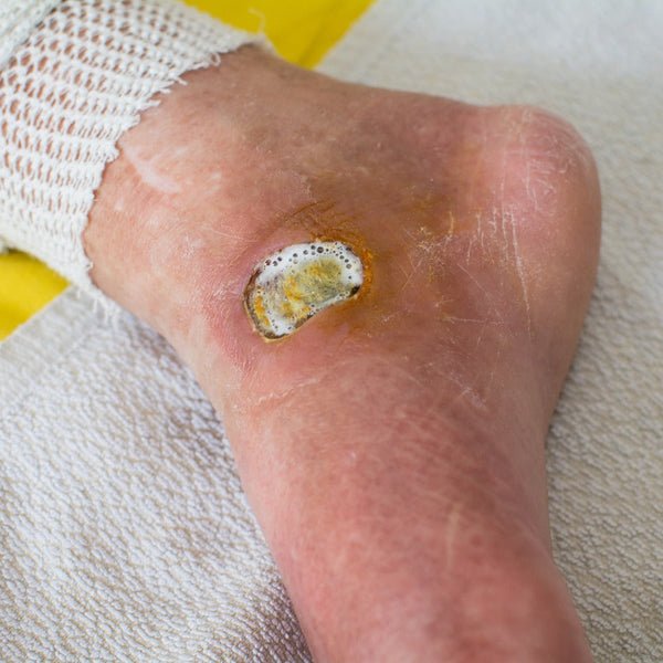 Diabetic Wound Ulcer