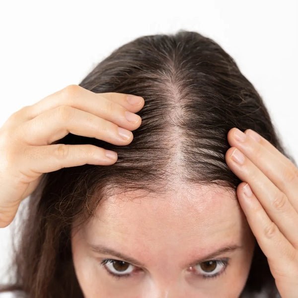 Hair Loss